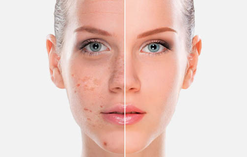 MeLine – Θεραπεία αποχρωματισμού