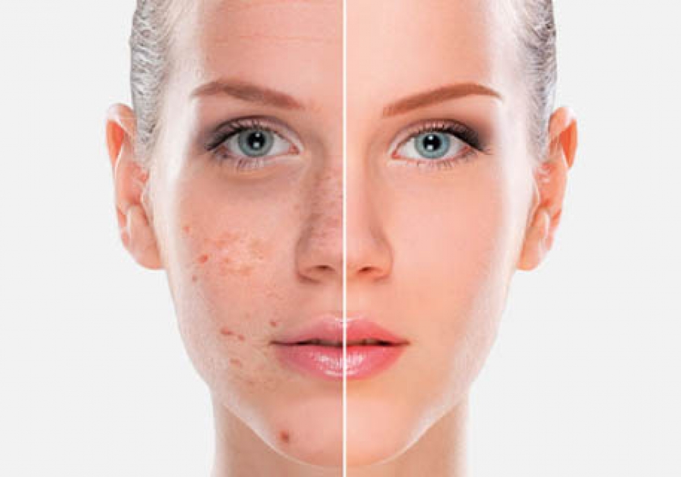 MeLine – Θεραπεία αποχρωματισμού MeLine – Θεραπεία αποχρωματισμού