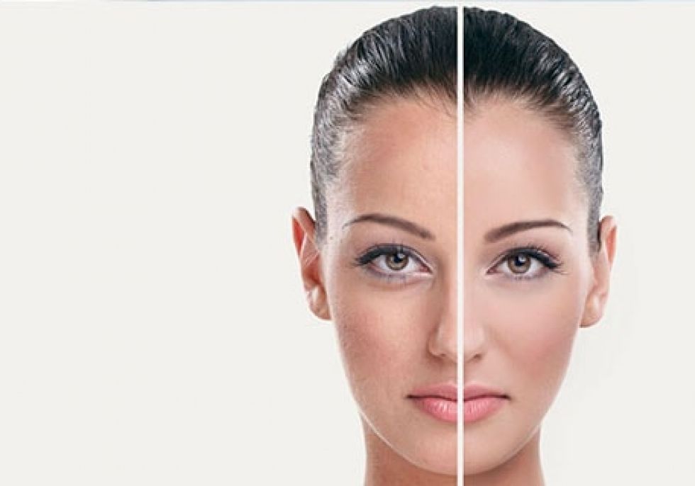 Vita Peel  - Μικροδερμοαπόξεση