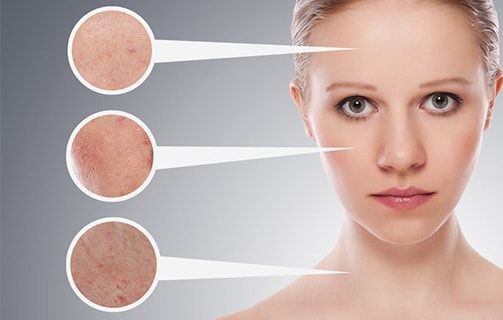 Βαθύς καθαρισμός για Ακμή