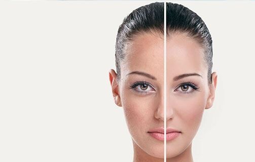 Vita Peel  - Μικροδερμοαπόξεση