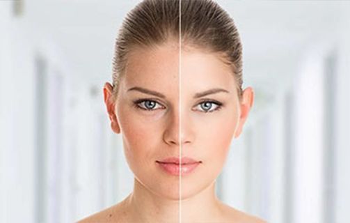 Βotoxlike – Σαν Βοtox